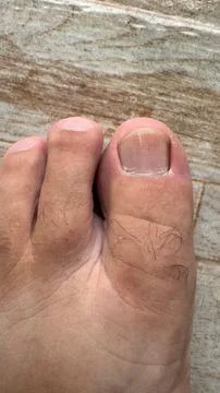 Problem nail Foto stock