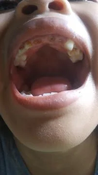 Problem teeth Stock Photos