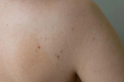 Problematic back skin with acne breakouts and inflamed pimples Stockfoto's
