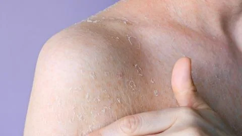Problematic dry skin on shoulder close-up front view flaking as consequence of Foto stock