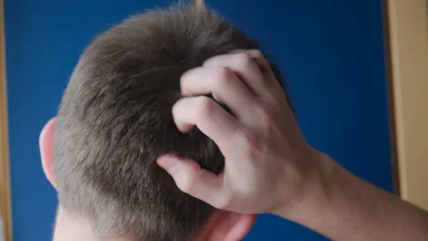 Problematic scalp: dandruff, rash, lice. A man scratches his head with his hand Stock Footage 125028238
