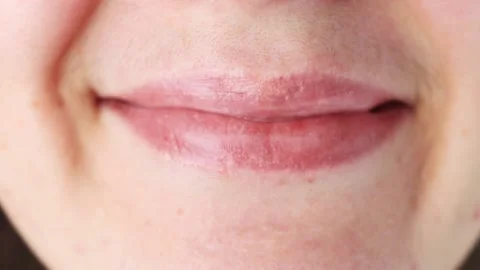 Problematic skin of the face close-up, a woman's mustache. Wrong metabolism Stock Footage 170476163