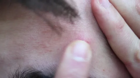 Problematic skin in a young man with dark hair. Acne on the forehead. Stock Footage 150100825