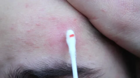 Problematic skin in a young man with dark hair. Acne on the forehead. Stock Footage 150100854