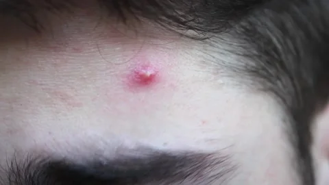 Problematic skin in a young man with dark hair. Acne on the forehead. Stock Footage 150100890