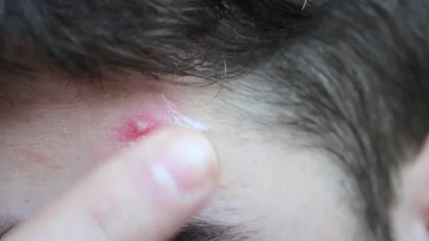 Problematic skin in a young man with dark hair. Acne on the forehead. Stock Footage 150100955