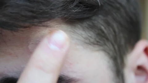 Problematic skin in a young man with dark hair. Acne on the forehead. Stock Footage 150101038