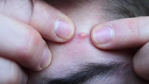 Problematic skin in a young man with dark hair. Acne on the forehead. Stock Footage 150101039