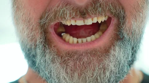 Problematic teeth with visible yellowing, plaque and tartar buildup in bearded Stock Footage 345125786