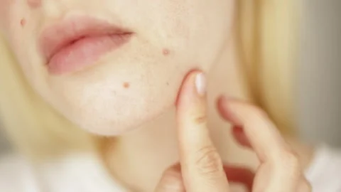 Problems face skin with acne and enlarged pores. Stock Footage 245812815