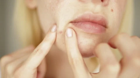 Problems face skin with acne and enlarged pores. Stock Footage 245812831