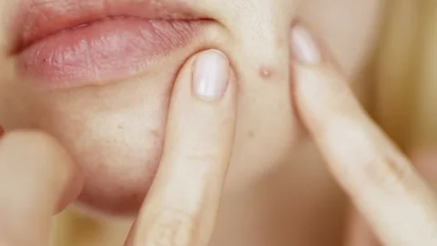 Problems face skin with acne and enlarged pores. Stock Footage 277848437