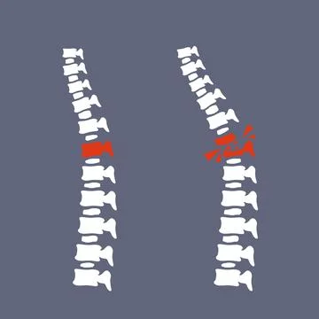 Problems with spine. Posture issues on blue background Illustrazione stock