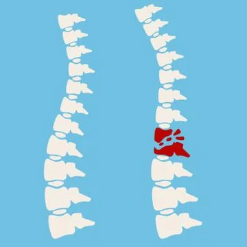 Problems with spine. Posture issues. Sick red place. Crack in White bone. Stock Illustration