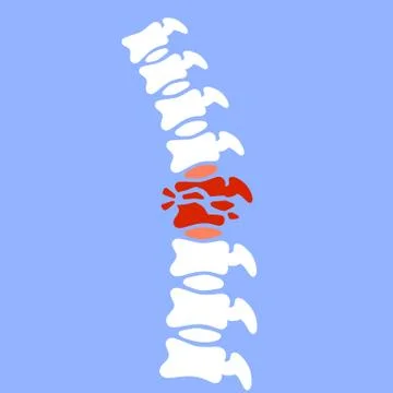 Problems with spine. Posture issues. Sick red place. vertebral column. Stock Illustration