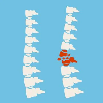 Problems with spine. Posture issues. Sick red place. Crack in White bone. Stock Illustration