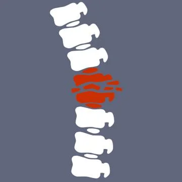 Problems with spine. Posture issues. vertebral column. Crack in the White bon Stock Illustration