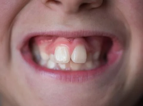 Problems with the teeth of a young boy. Not the correct bite Stock Photos