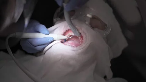 Procedure for cleaning teeth from plaque and tartar using an air abrasion device Stock Footage 261996781