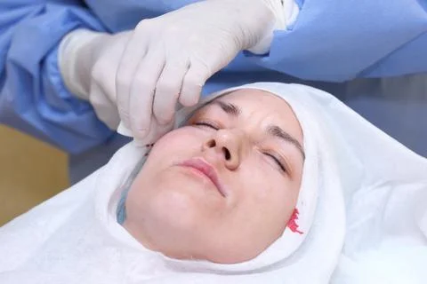 Procedure of face lifting surgery. Stock Photos