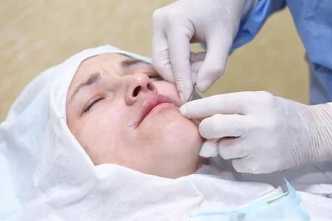 Procedure of face lifting surgery. Stock Photos