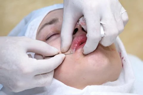 Procedure of face lifting surgery. Stock Photos