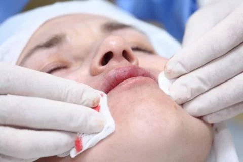 Procedure of face lifting surgery. Photos