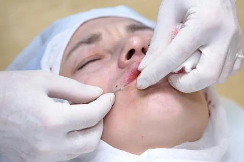 Procedure of face lifting surgery. Stock Photos