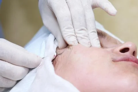 Procedure of face lifting surgery. Stock Photos