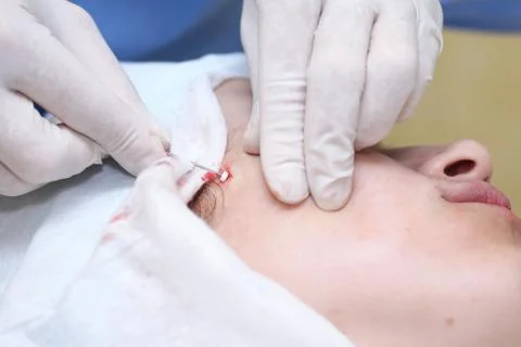 Procedure of face lifting surgery. Stock Photos