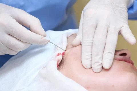 Procedure of face lifting surgery. Stock Photos