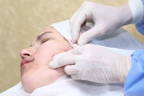 Procedure of face lifting surgery. Stock Photos