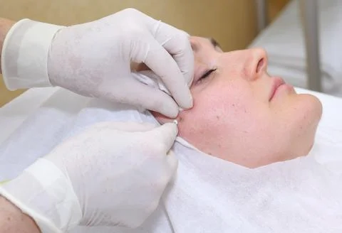 Procedure of face lifting surgery. Stock Photos