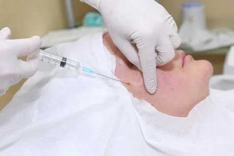 Procedure of face lifting surgery. Stock Photos