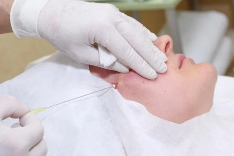 Procedure of face lifting surgery. Stock Photos