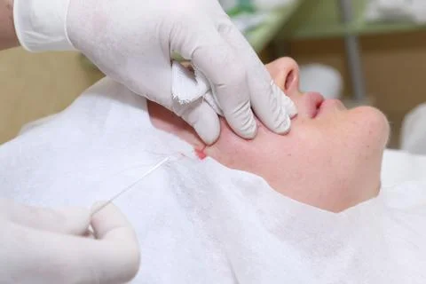 Procedure of face lifting surgery. Stock Photos