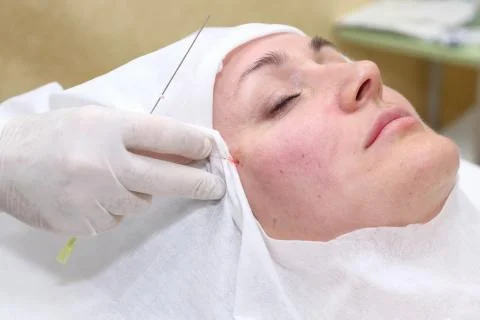 Procedure of face lifting surgery. Stock Photos