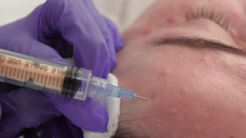 Procedure Facial Injection Stock-Footage 287958996
