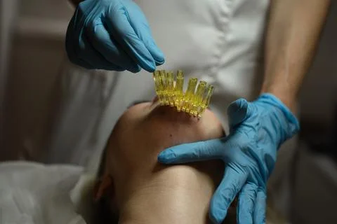 Procedure of inserting PDO threads under the skin, facelift. Thread lifting. Foto stock
