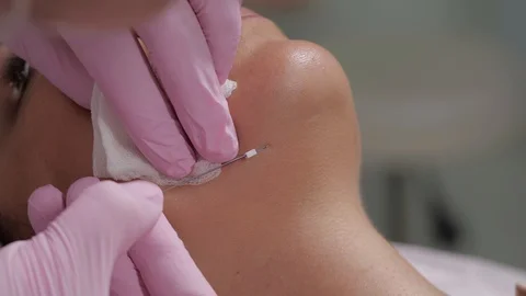 The procedure of lifting the face using special threads. Stock Footage 125798930