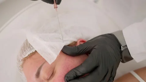 The procedure of lifting the face using special threads. Stock Footage 243635577