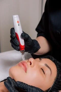 Procedure of Micro-Needle RF Lifting Face Skin Close Up. Skin Augmentation Stock Photos
