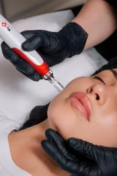 Procedure of Micro-Needle RF Lifting Face Skin Close Up. Skin Augmentation Stock Photos