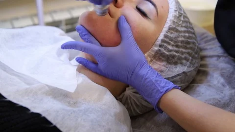 Procedure of Microdermabrasion. Stock Footage 88078178
