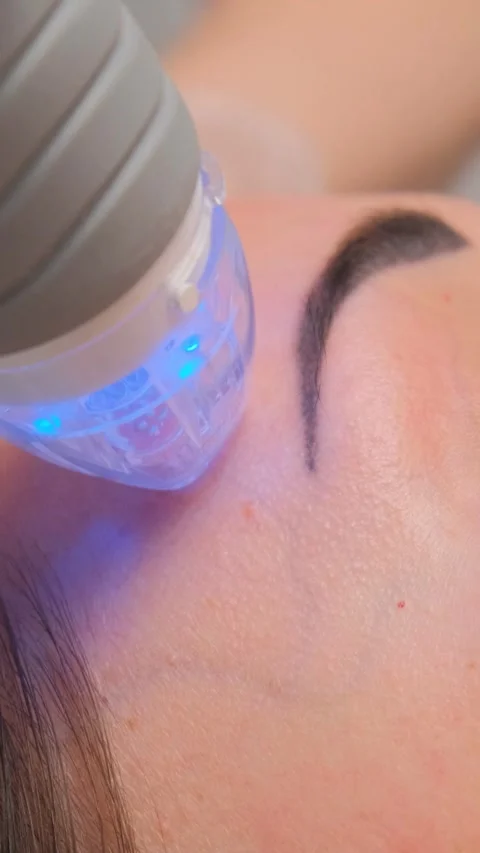 Procedure needle fractional RF for face lifting in a beauty clinic Stock Footage 278368945