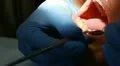 Procedure of teeth polishing (female) HD Footage