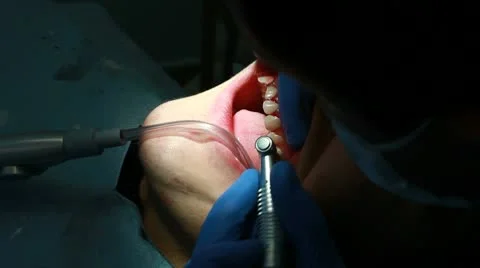 Procedure of teeth polishing Stock Footage 10718261
