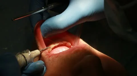 Procedure of teeth polishing Stock Footage 10718299