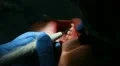 Procedure of teeth polishing HD Footage