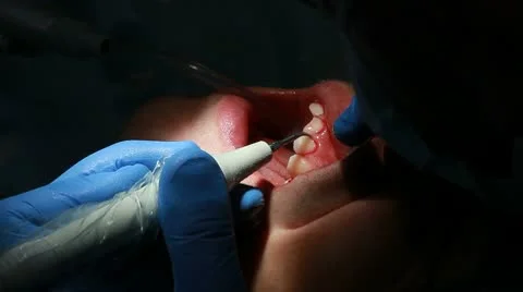 Procedure of teeth polishing Stock Footage 10718333